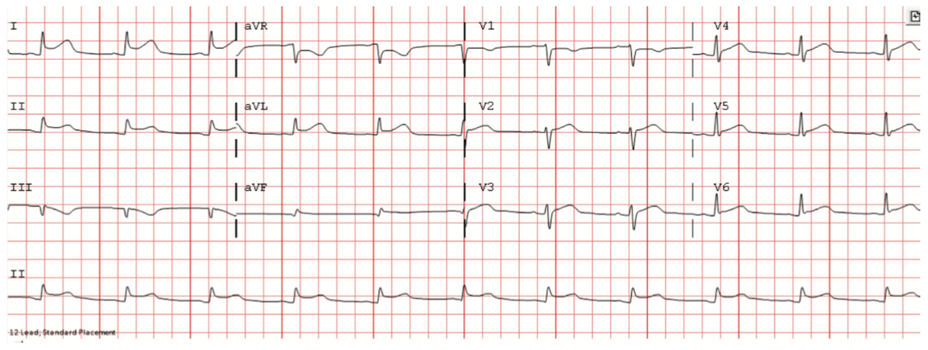 Pericarditis A Classic Electrocardiogram
